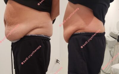 Science Behind Body Contouring