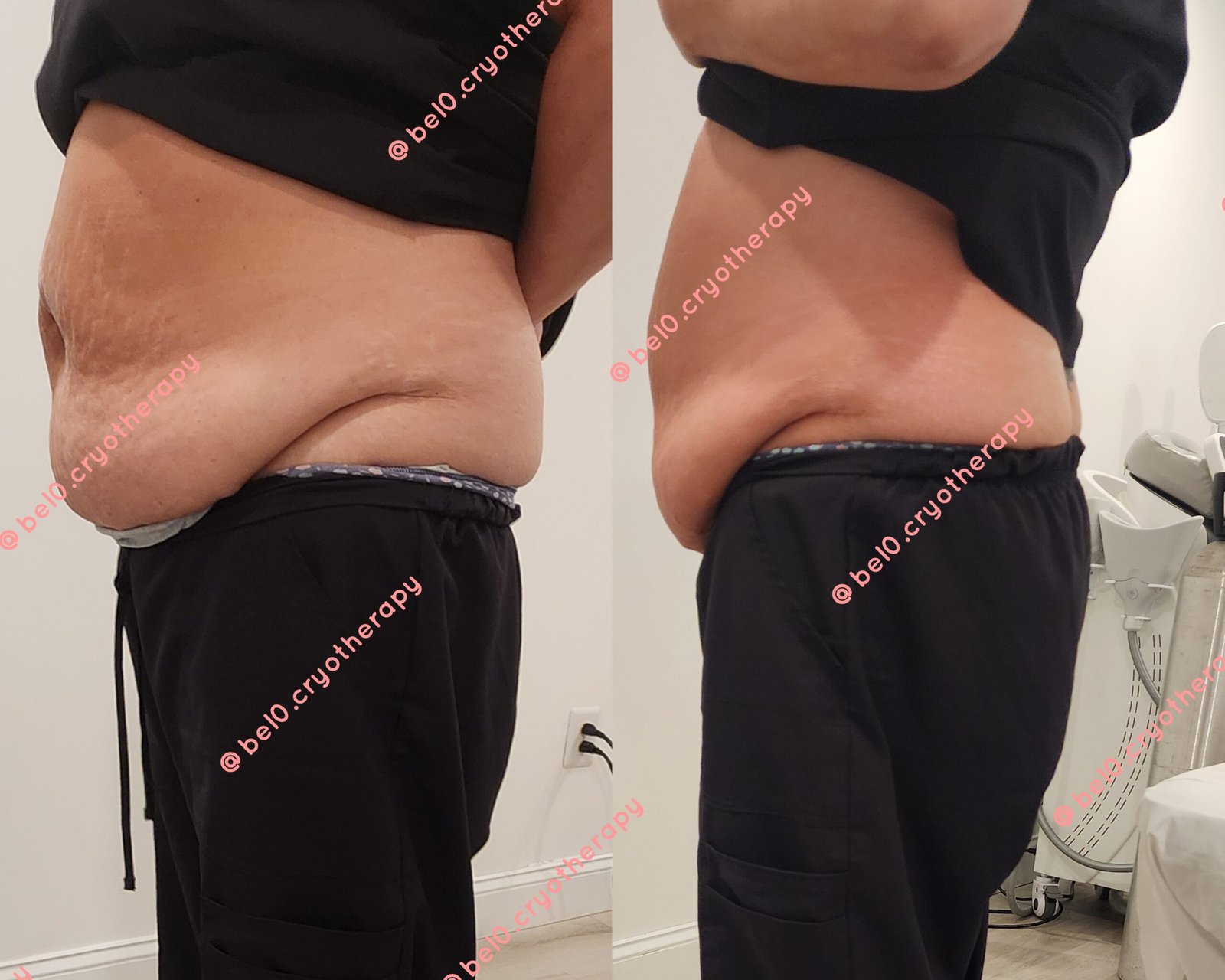 targeted fat reduction