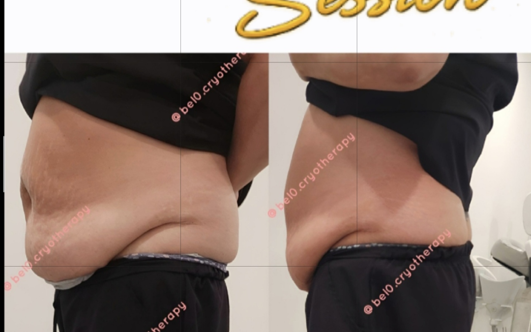 Exploring the Most Effective Areas for Body Contouring: A Comprehensive Guide to Cryoslimming Targets