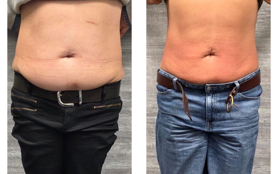 How Can You Maintain Results After a Body Contouring Treatment?