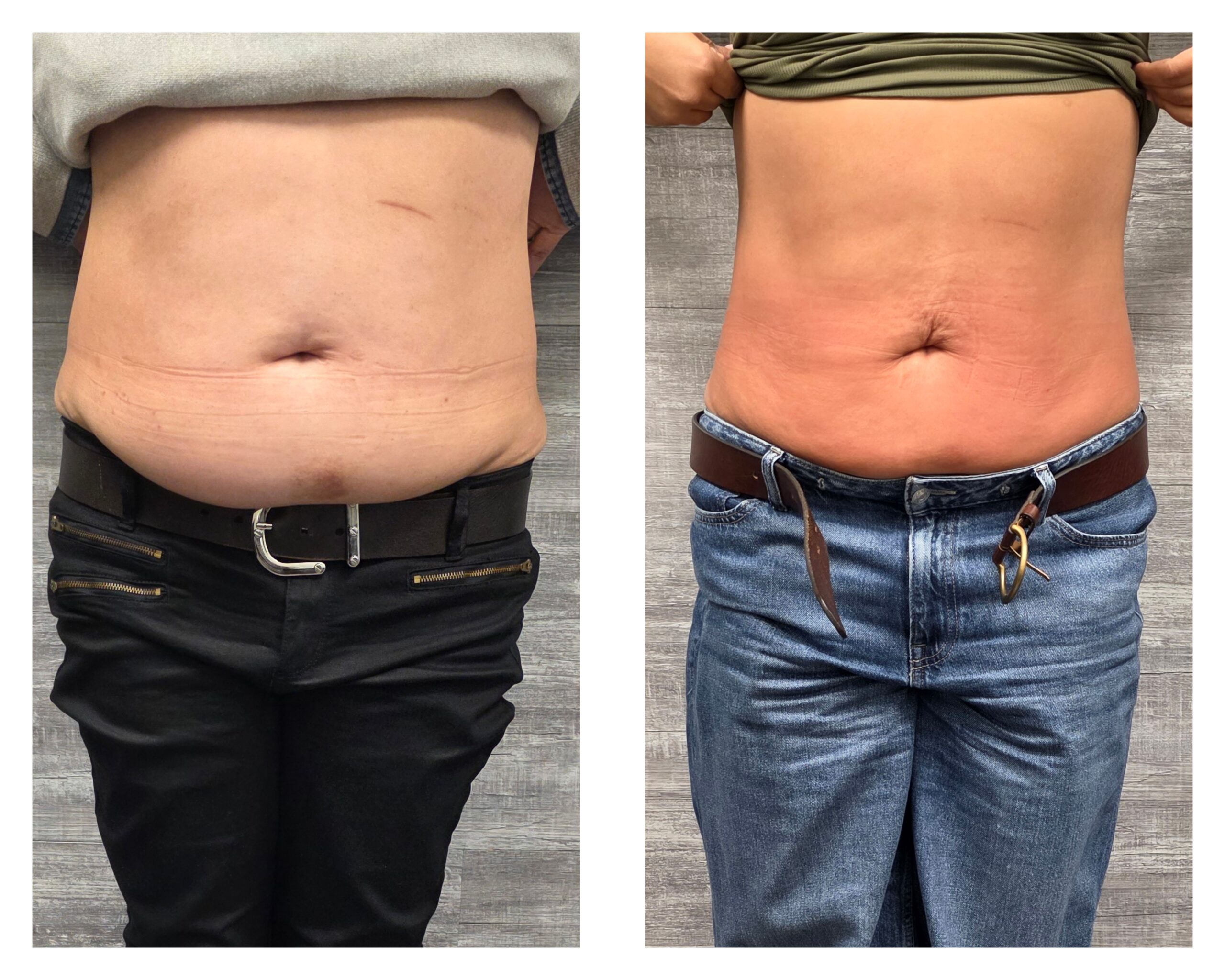 Body contouring near Essex Fells NJ at Bel0 Cryotherapy