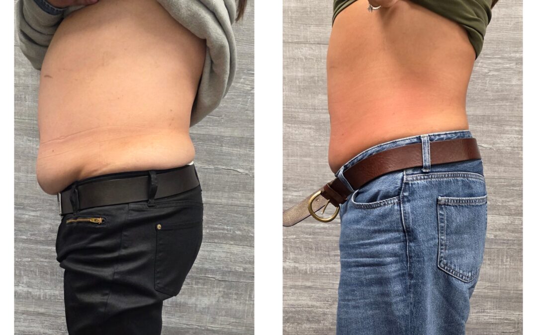 Body Contouring In East Hanover NJ