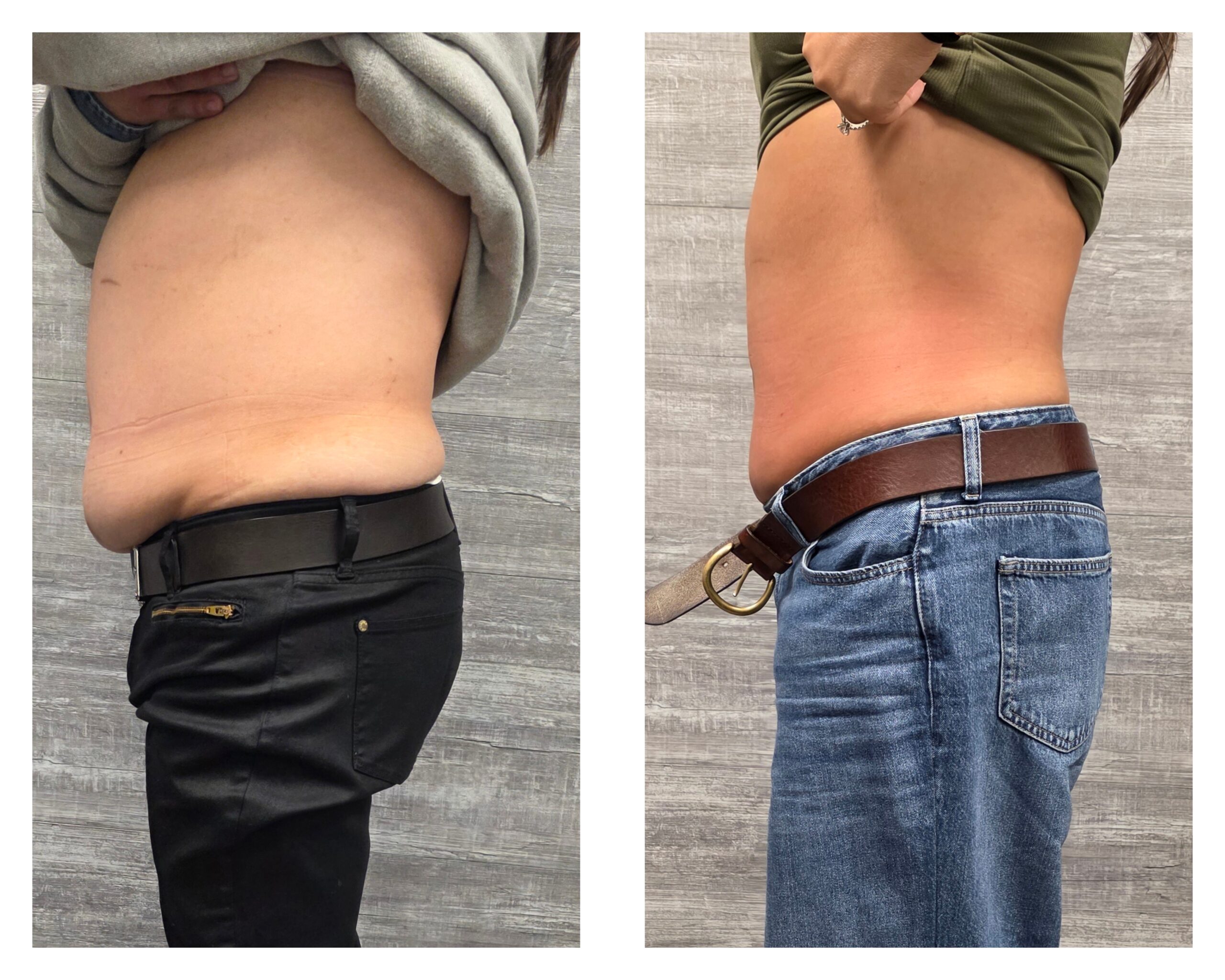 body contouring near cedar grove nj bel0 cryotherapy