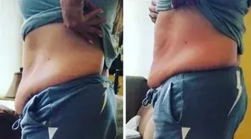 Bel0 Cryotherapy client before and after body contouring comparison 4