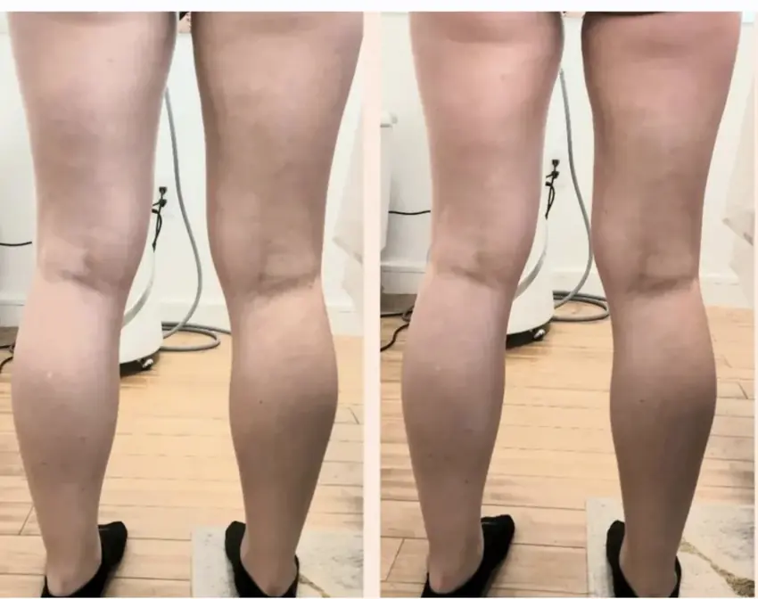 Bel0 Cryotherapy client before and after body contouring comparison 11