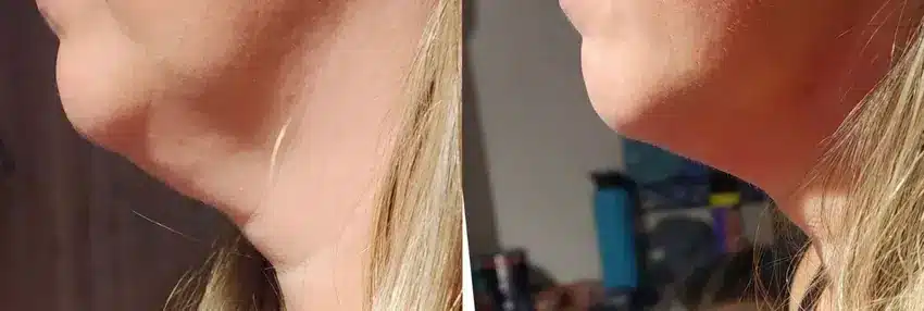 Bel0 Cryotherapy client before and after body contouring comparison 12