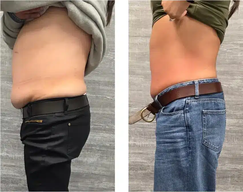 Bel0 Cryotherapy client before and after body contouring comparison 14